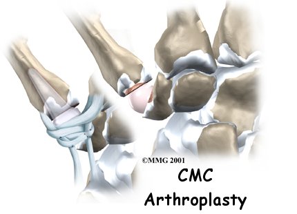 Artificial Joint Replacement of the Thumb - Galena Sport Physical Therapy's Guide