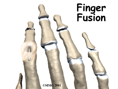 Finger Fusion Surgery - Galena Sport Physical Therapy's Guide