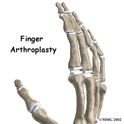 Artificial Joint Replacement of the Finger - Galena Sport Physical Therapy's Guide